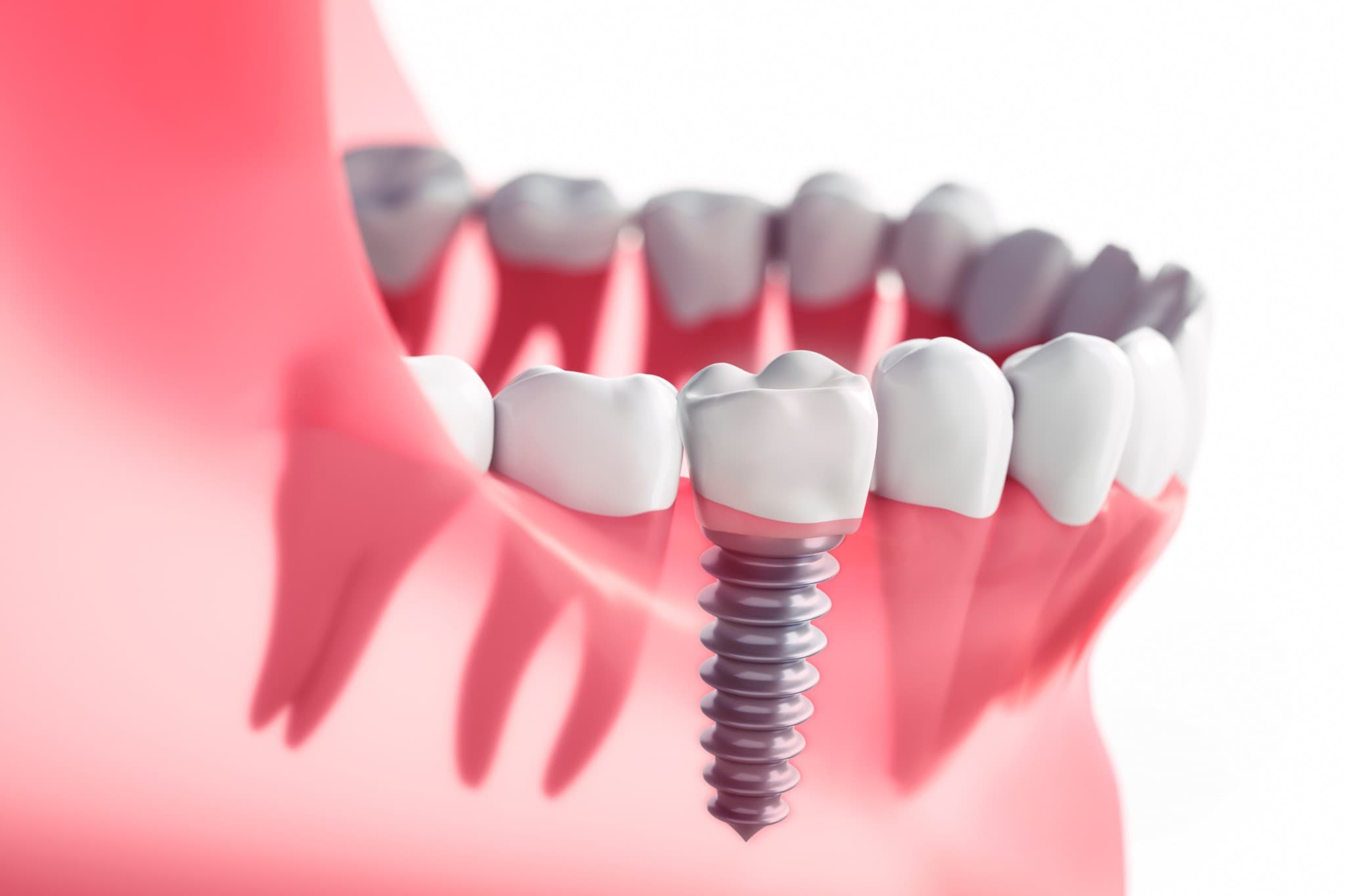Implants dentaires