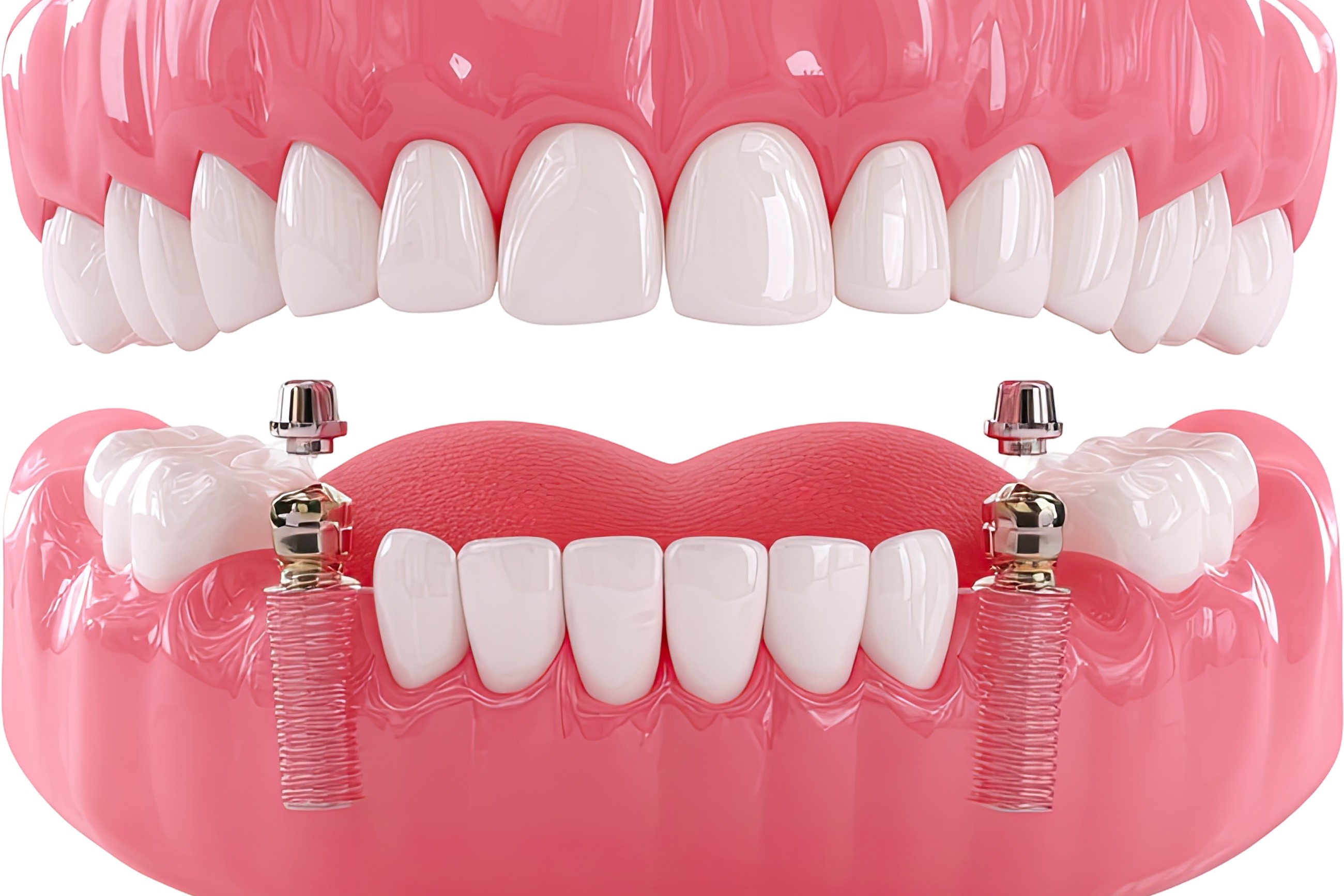 Implants dentaires